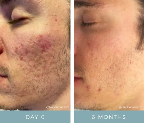 Before + After - Acne