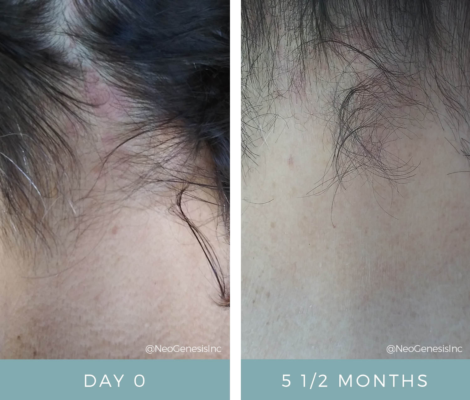 Before + After - Psoriasis around the neck and on scalp