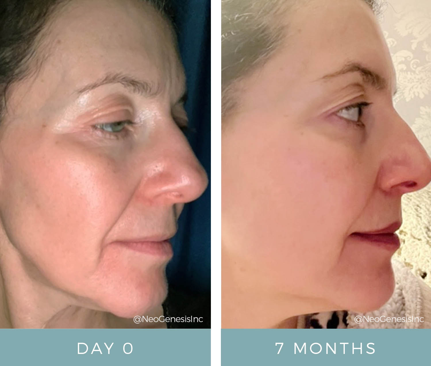 Before + After - Aging Skin