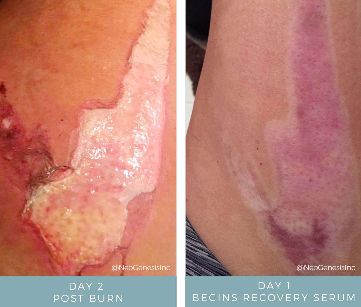 Before + After - Wound Care - Hot Oil Burn