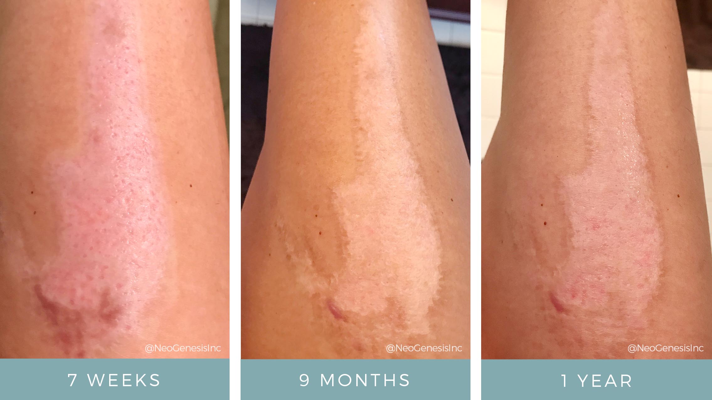 Before + After - Wound Care - Hot Oil Burn