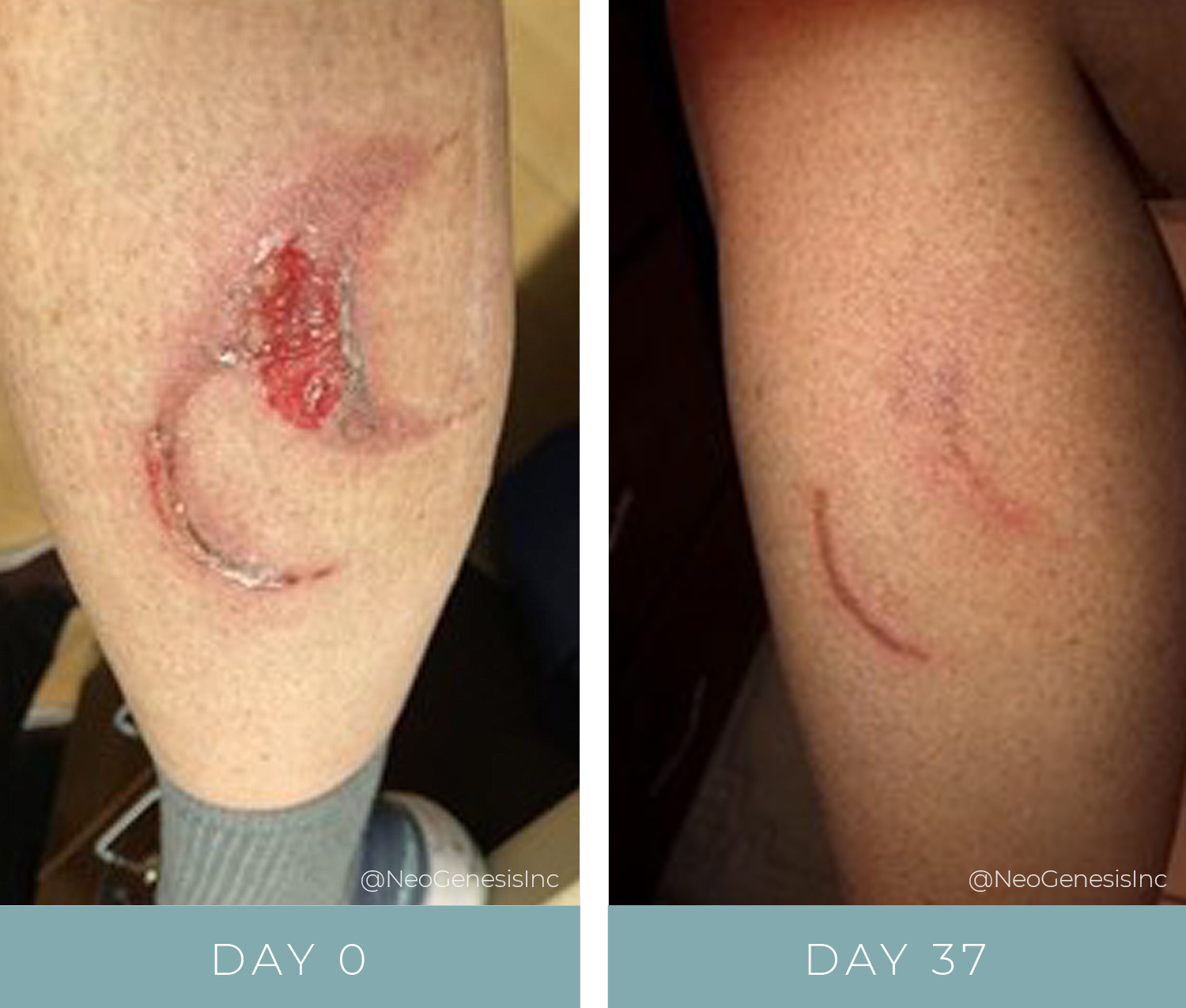 Before + After - Wound Care - Burn