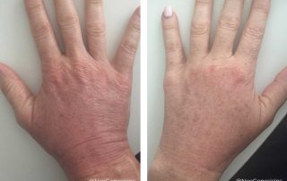 Before + After - Fraxel Laser