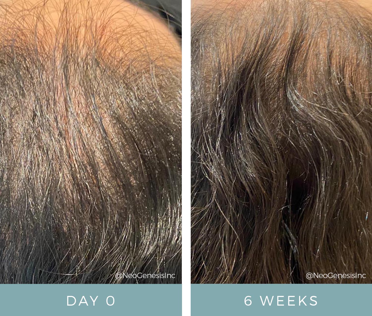 Before + After - Hair Loss + Microneedling