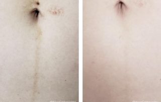 Before + After - Post Pregnancy Scar