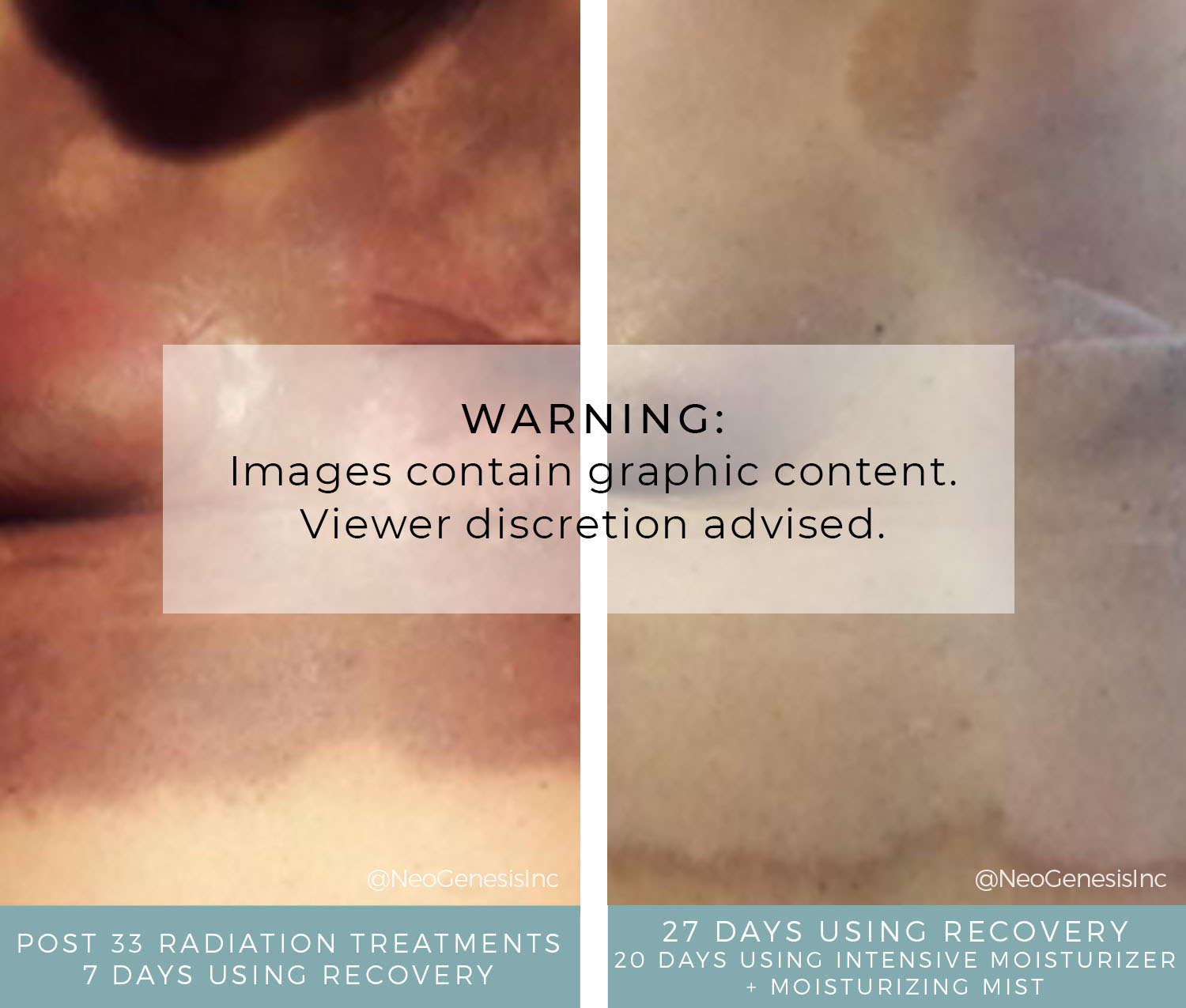 Before + After - Radiation