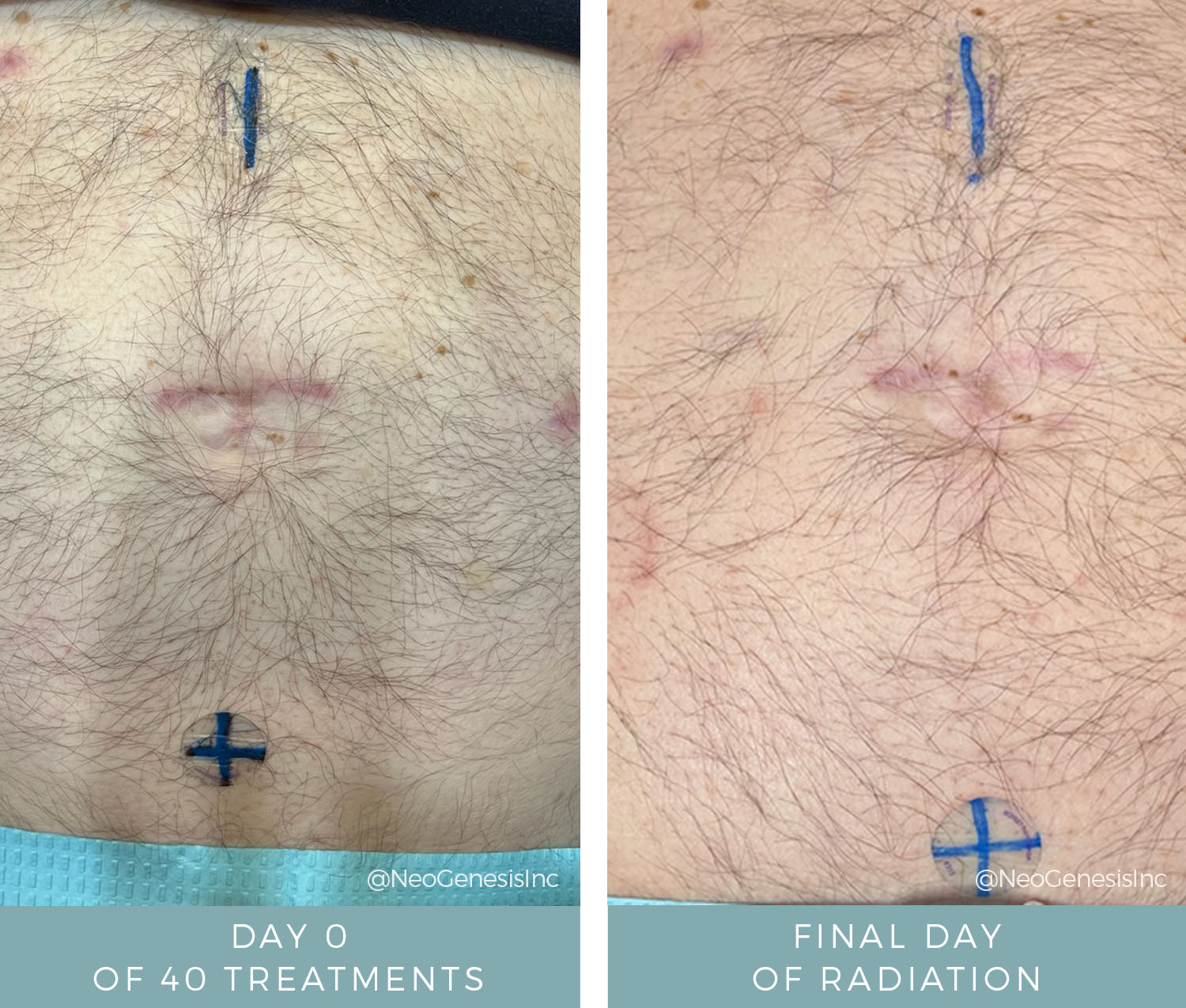 Before + After - Radiation for Prostate Cancer