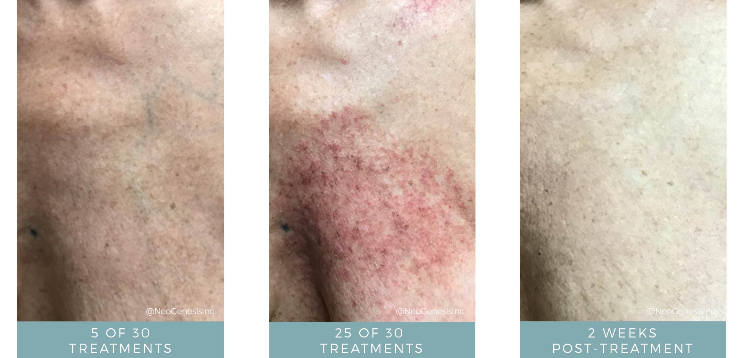 Before + After - Radiation Dermatitis