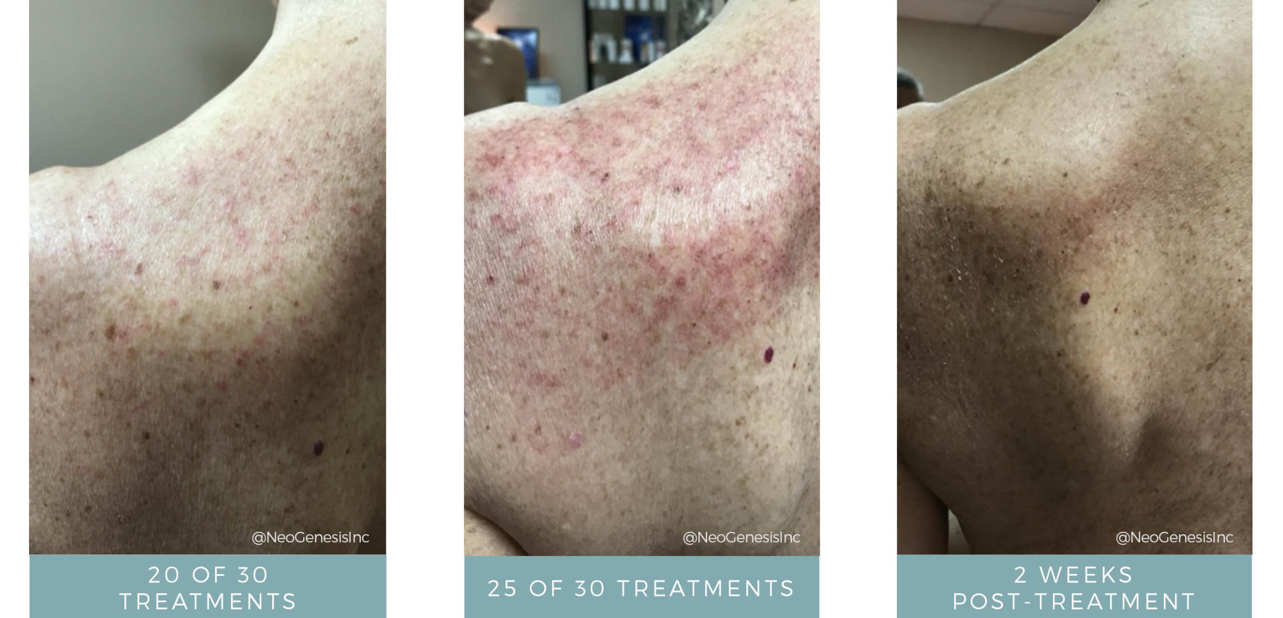 Before + After - Radiation Dermatitis