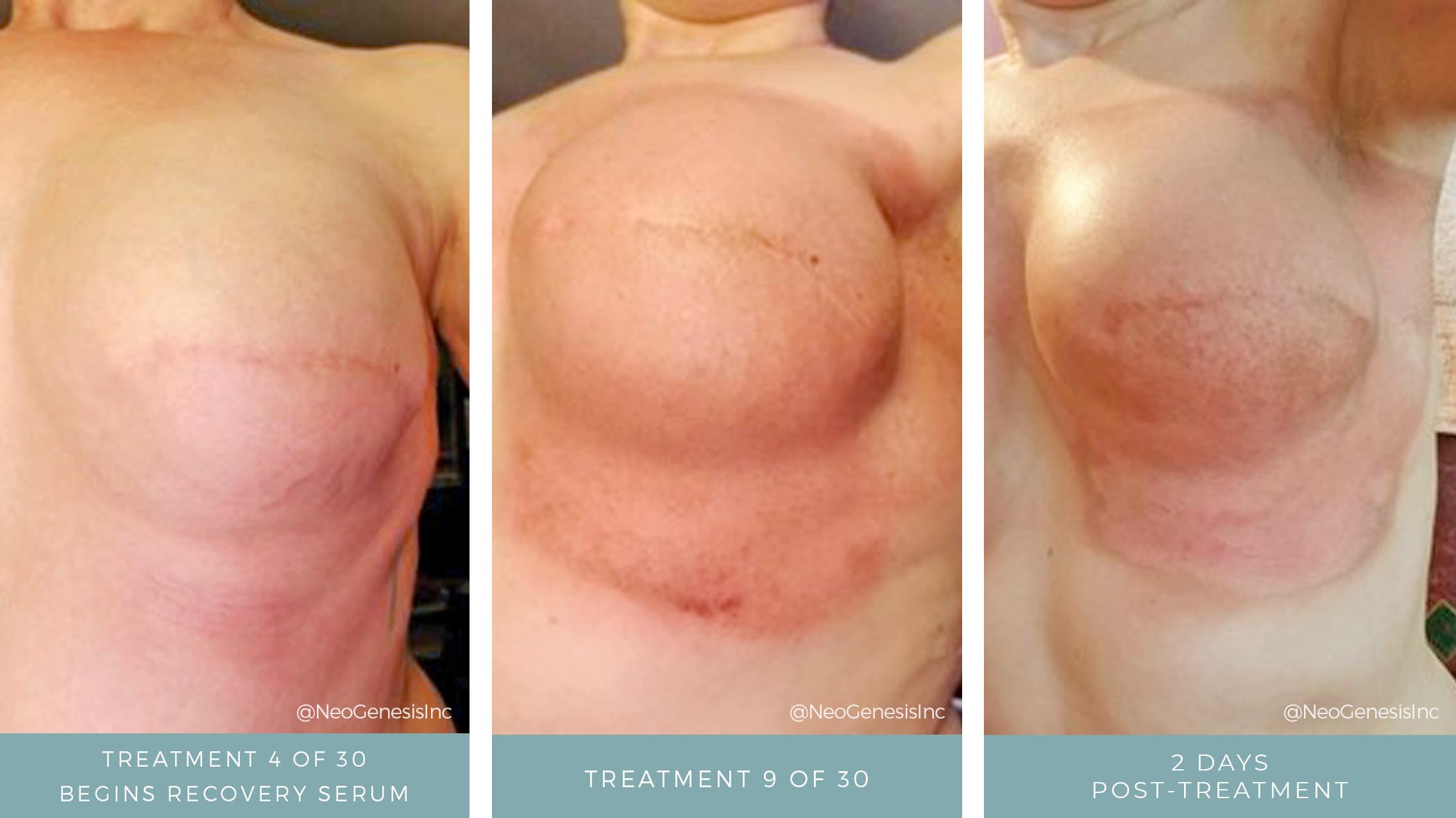 Before + After - Radiation for Breast Cancer