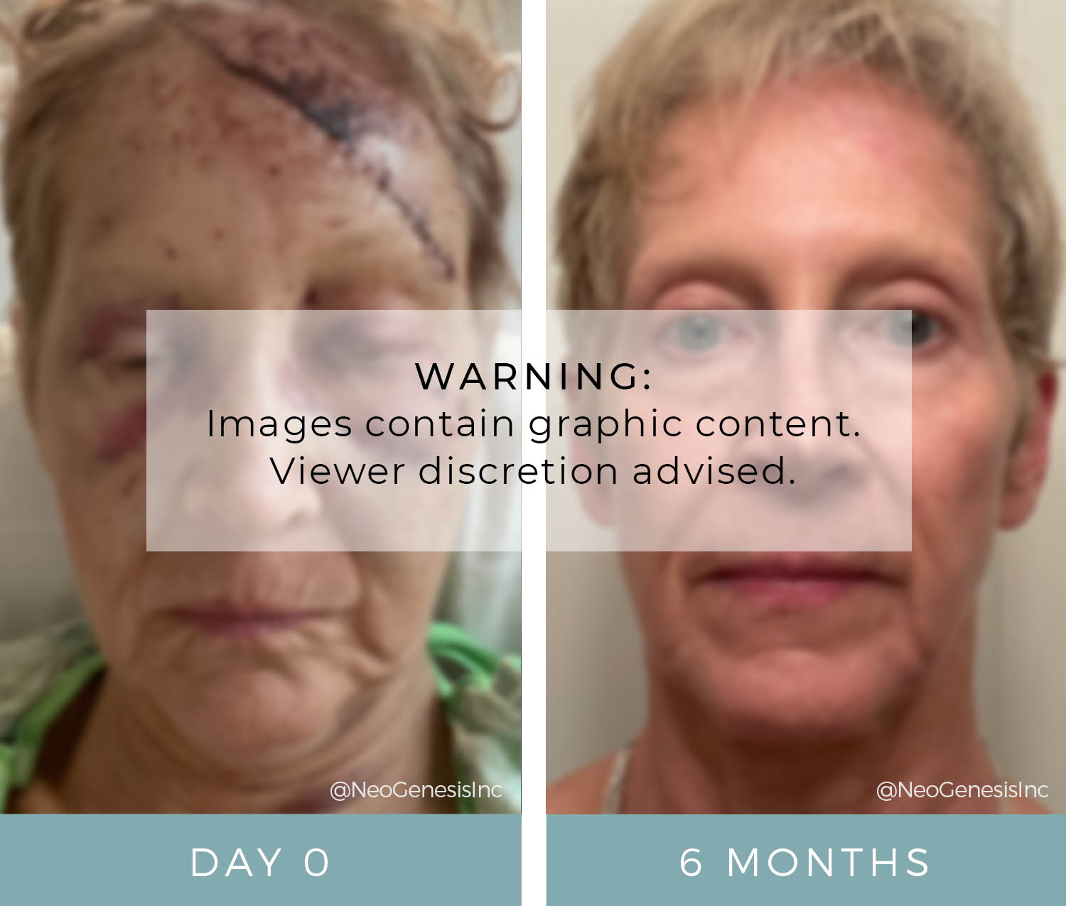 Before + After - Wound Care - Car Accident