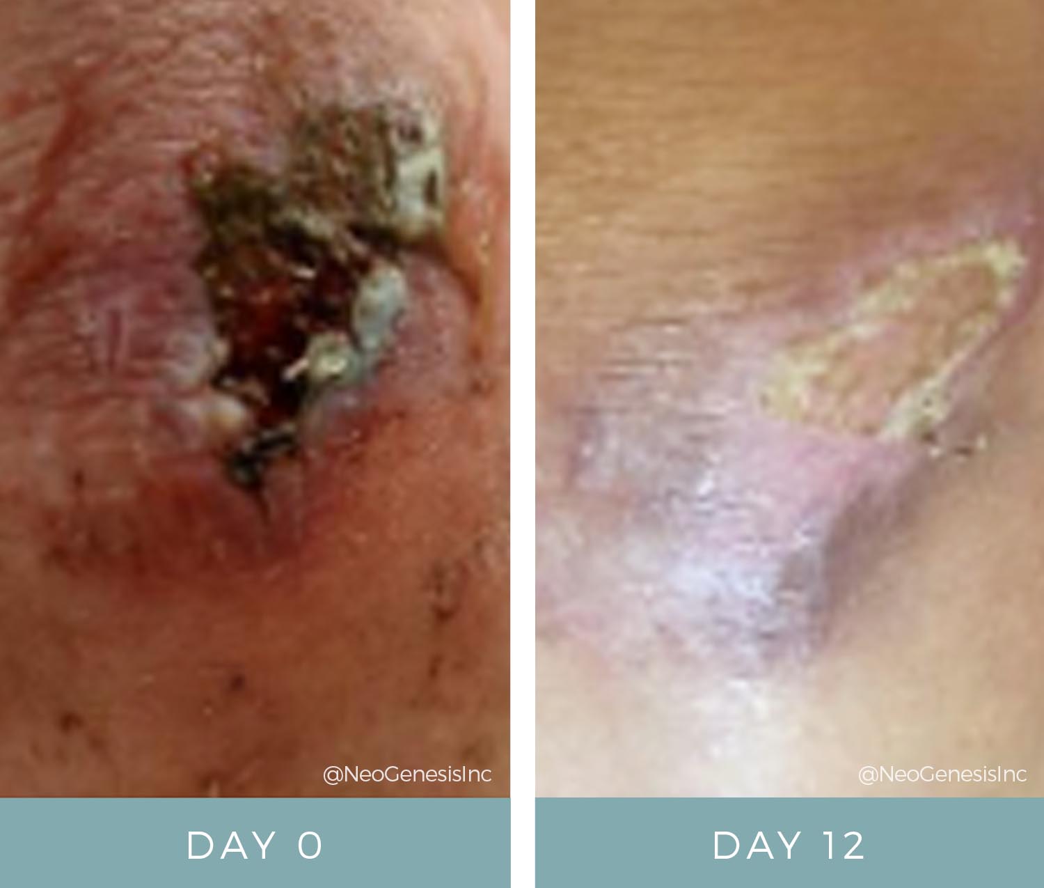 Before + After - Wound Care