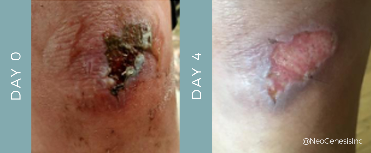 Before + After - Wound Care