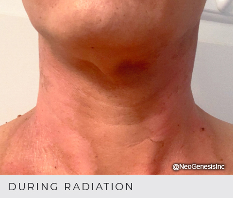 Radiation burns after 25 treatments