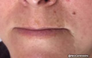 After - Rosacea