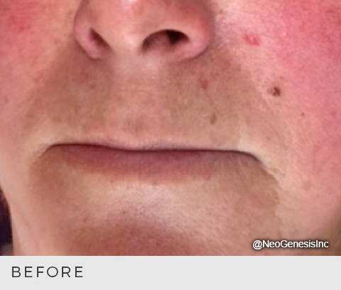 Before - Rosacea