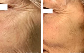 Before + After - Fibroblast