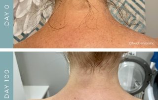 Before + After - Radiation + Chemo