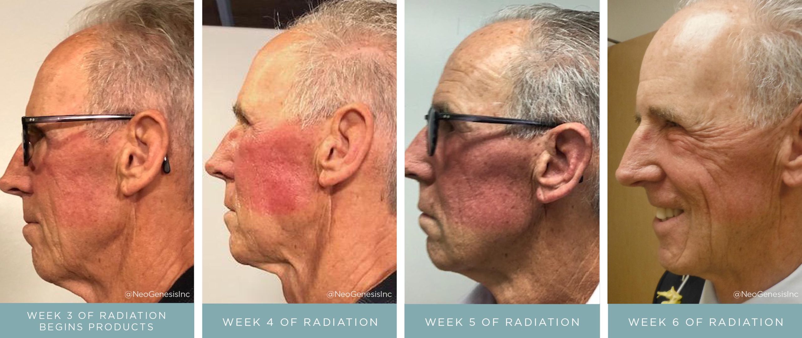 Before + After - Radiation Dermatitis