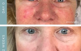 Before + After - Rosacea