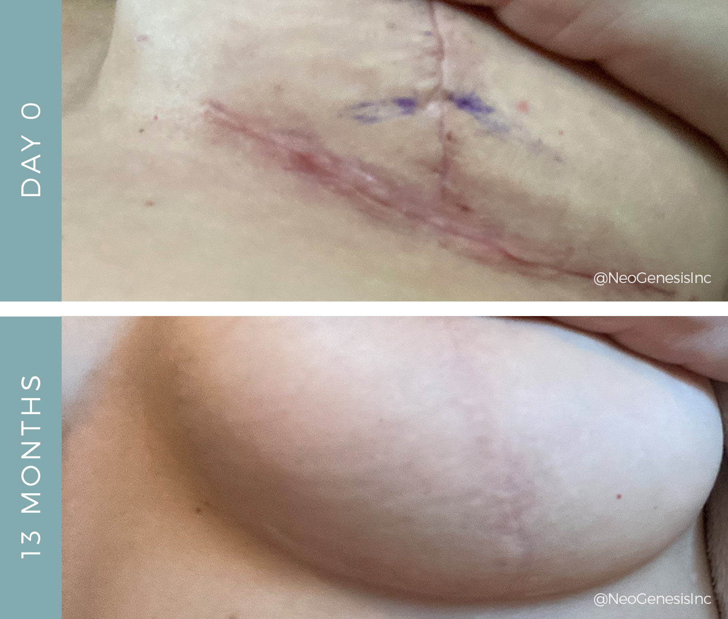 Before + After - Capsulectomy Surgery